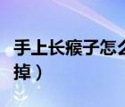 手上长瘊子怎么去掉图片（手上长瘊子怎么去掉）