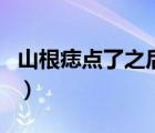 山根痣点了之后后悔了（山根有痣需要点掉吗）