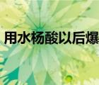 用水杨酸以后爆痘（用水杨酸后爆痘正常吗）
