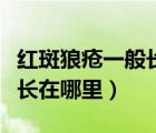 红斑狼疮一般长在哪里会痒吗（红斑狼疮一般长在哪里）