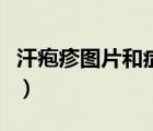 汗疱疹图片和症状图片怎么治疗（汗疱疹图片）