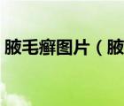 腋毛癣图片（腋毛有白色附着物是什么东西）