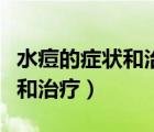 水痘的症状和治疗一般几天能好（水痘的症状和治疗）