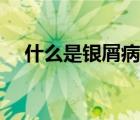 什么是银屑病症状特征（什么是银屑病）