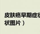 皮肤癌早期症状图片皮肤瘙痒（皮肤癌早期症状图片）