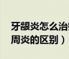 牙龈炎怎么治疗最有效 好得快（牙龈炎和牙周炎的区别）