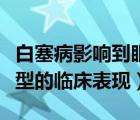 白塞病影响到眼睛怎么治疗（白塞病眼部最典型的临床表现）